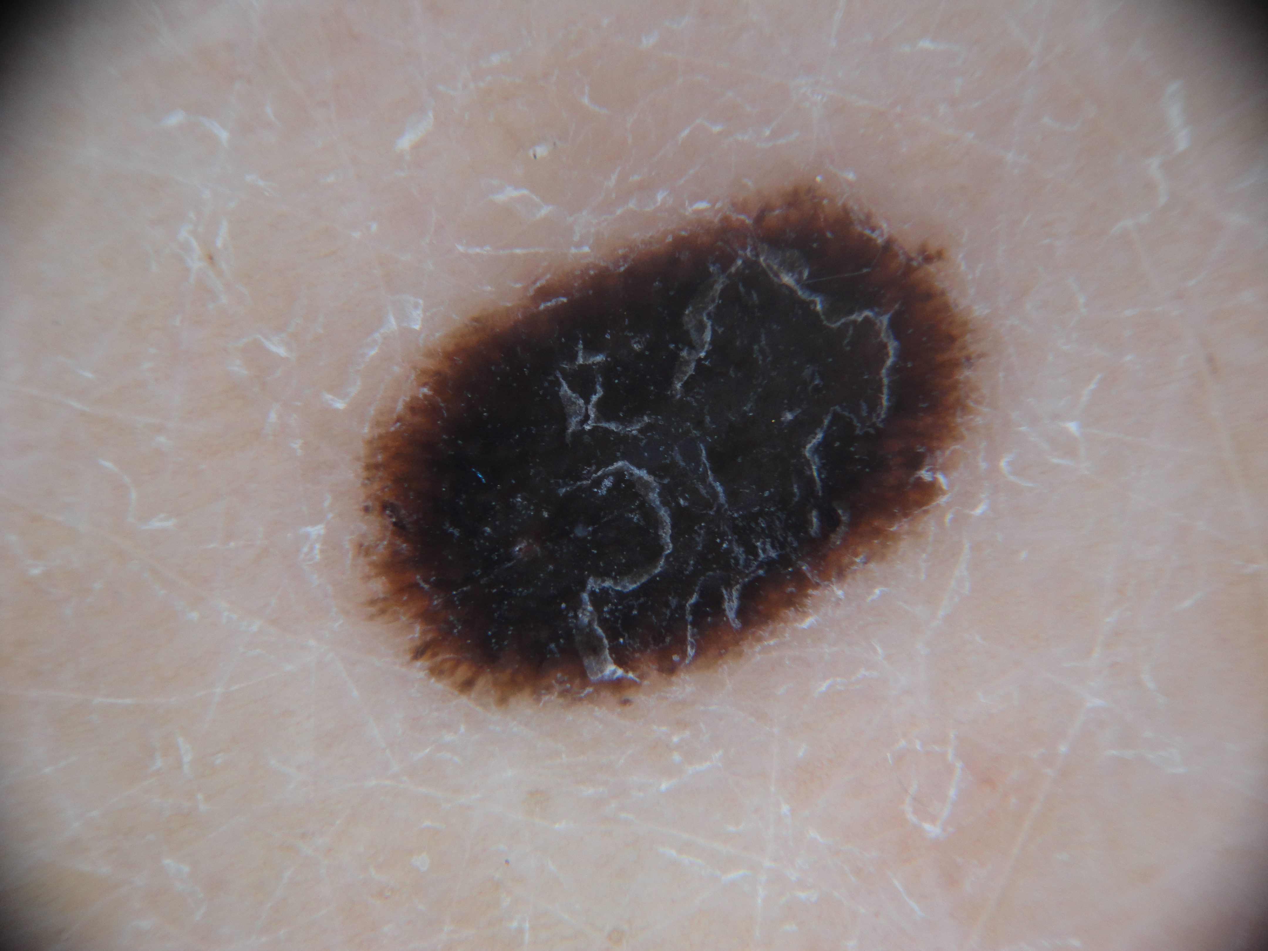 Melanoma